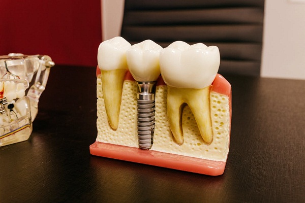 A model of tooth implant